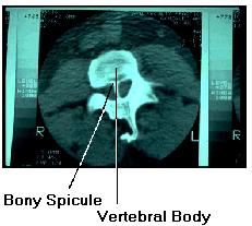 Bony Spicule